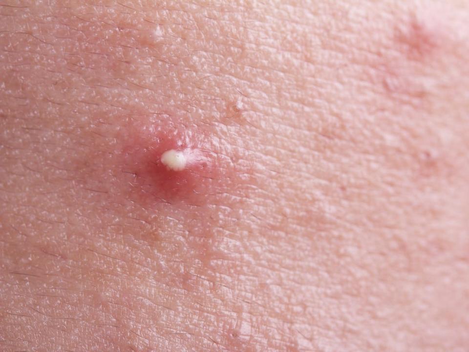 acne pustule