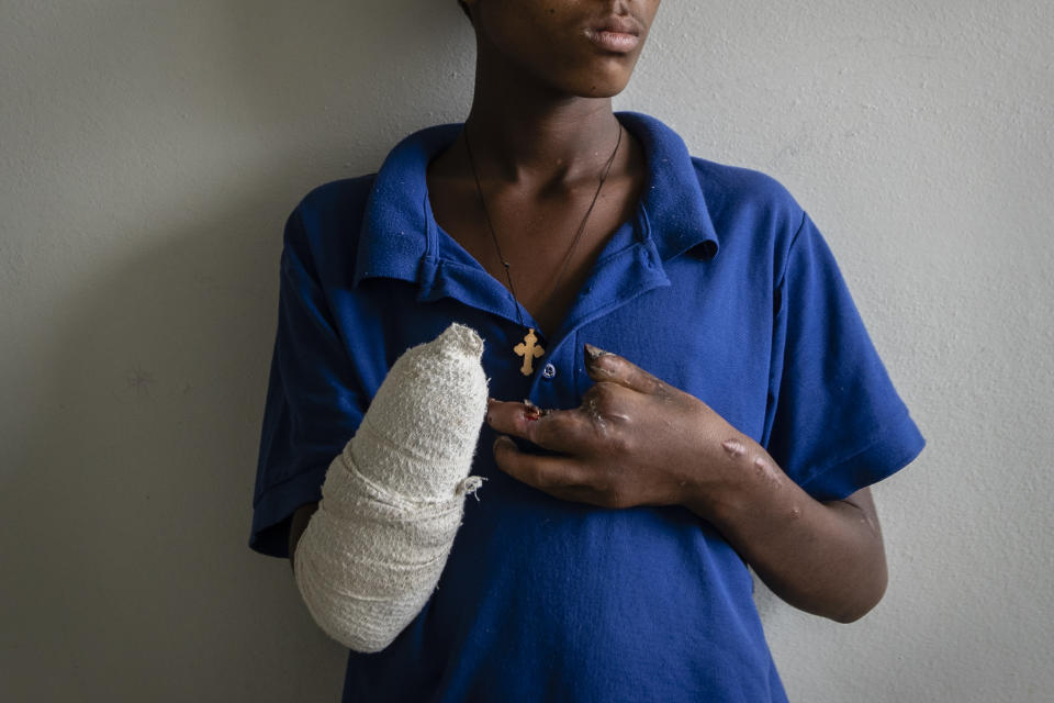Haftom Gebretsadik, a 17-year-old from Freweini near Hawzen who had his right hand amputated and lost fingers on his left after an artillery round struck his home in March, sits on his bed at the Ayder Referral Hospital in Mekele, in the Tigray region of northern Ethiopia, on Thursday, May 6, 2021. “I am very worried,” he says. “How can I work?” (AP Photo/Ben Curtis)
