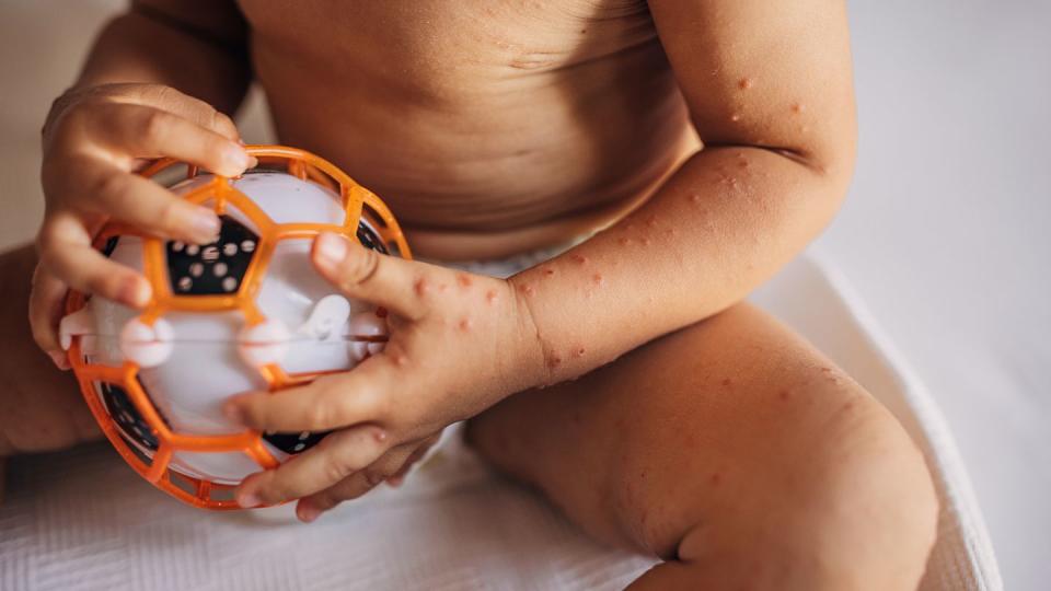 child with with hand foot and mouth disease