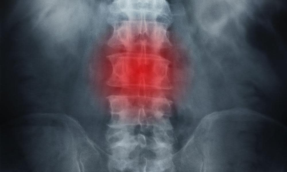 X-ray of spine showing back ache