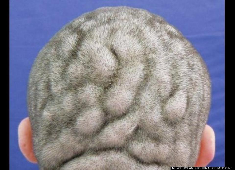 The man has a condition called cutis verticis gyrata, which is when the scalp has "ridges and furrows resembling the brain's surface."