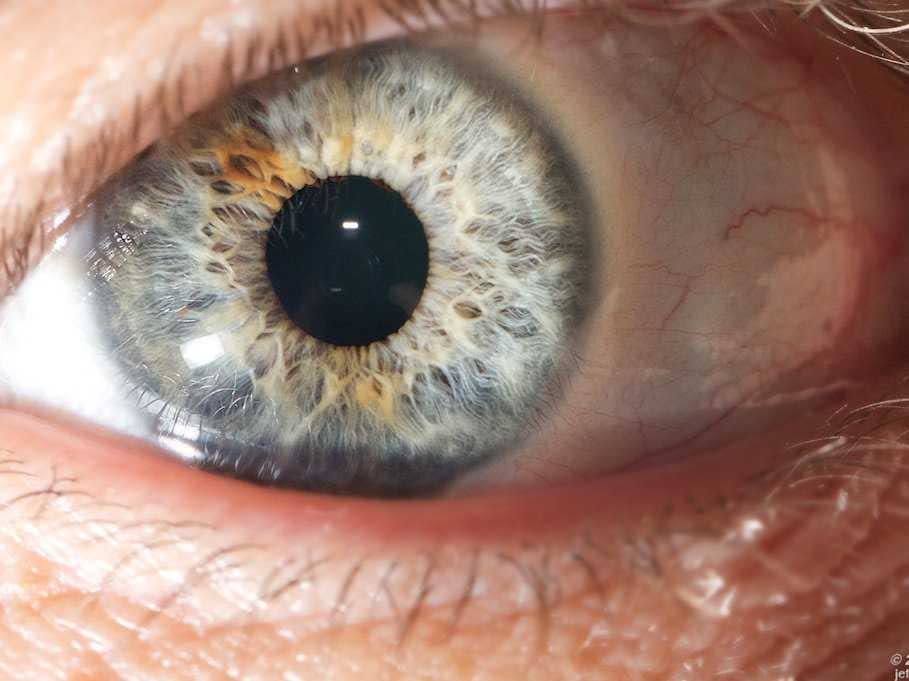 Eye