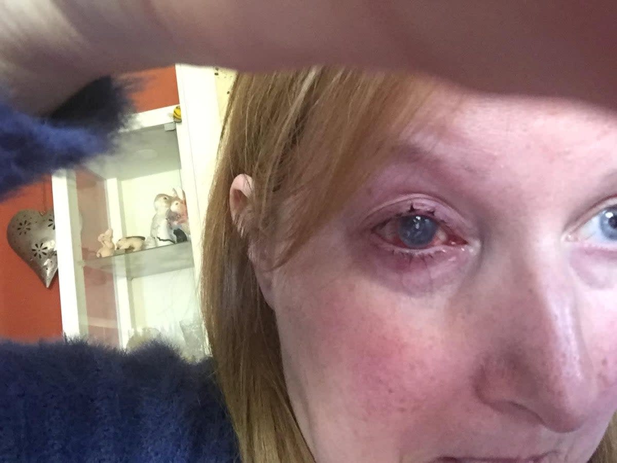 Marie Mason's eye three years after being diagnosed (Marie Mason / SWNS)