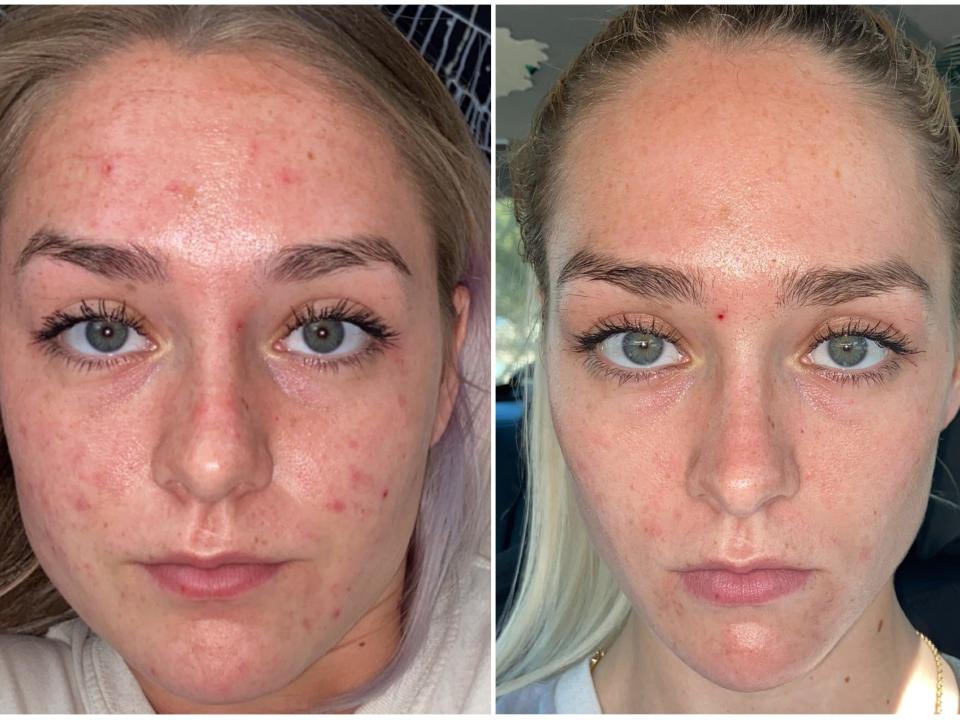 Trena Reeves, a woman with cystic acne, before treatment in 2021 and after treatment in 2022.