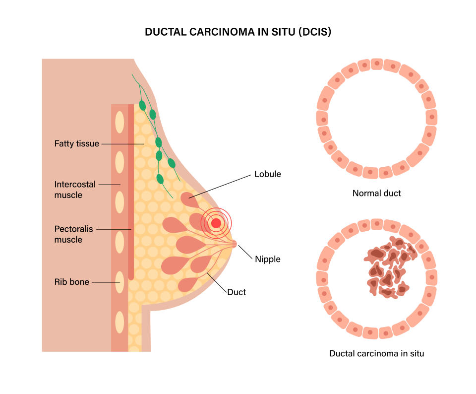 Ductal carcinoma in situ, pain and inflammation in female breast medical poster. Medical exam and laboratory research concept. Nipple, lobule, duct channel in woman silhouette flat vector illustration