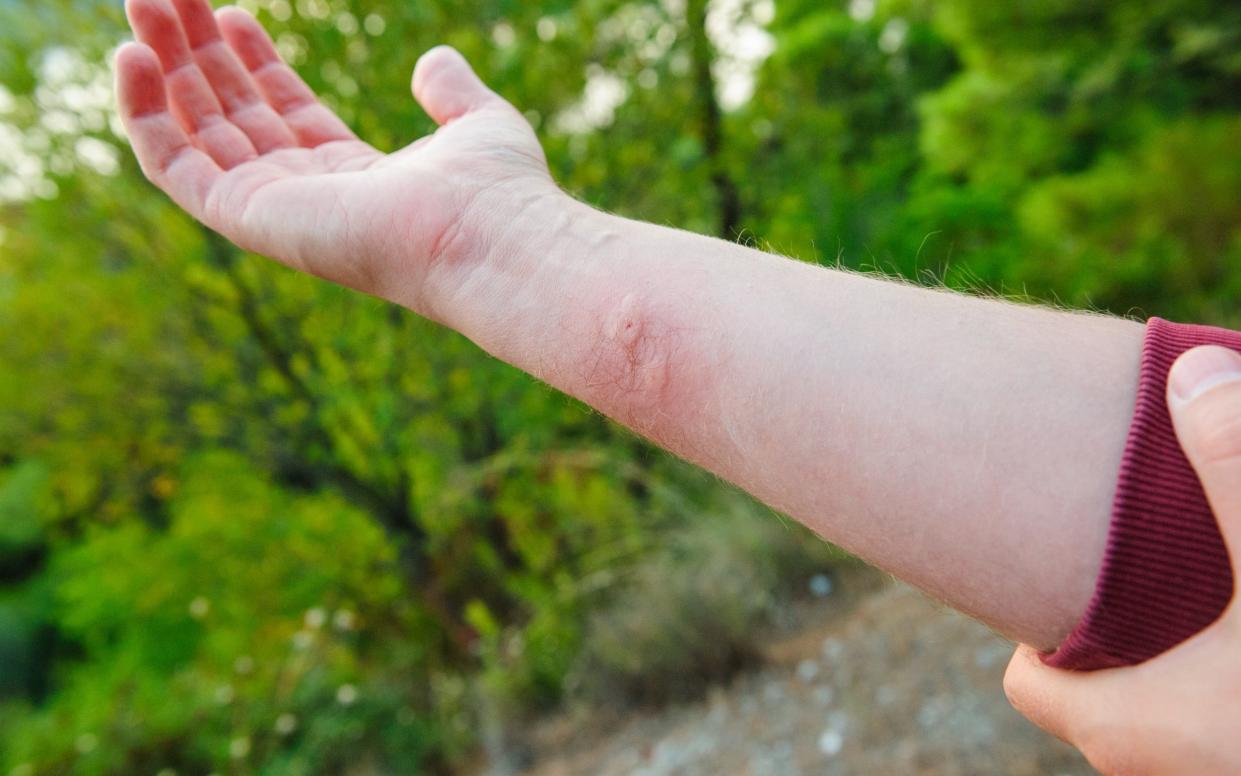 The distinctive red welt caused by a wasp sting