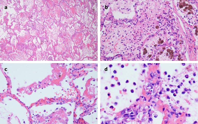 Coronavirus lung autopsies showing many small sources of inflammation