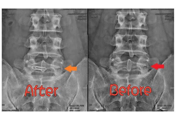 腰痛坐立難安 竟是腰椎椎弓骨折 水介質震波免開刀 紓緩疼痛