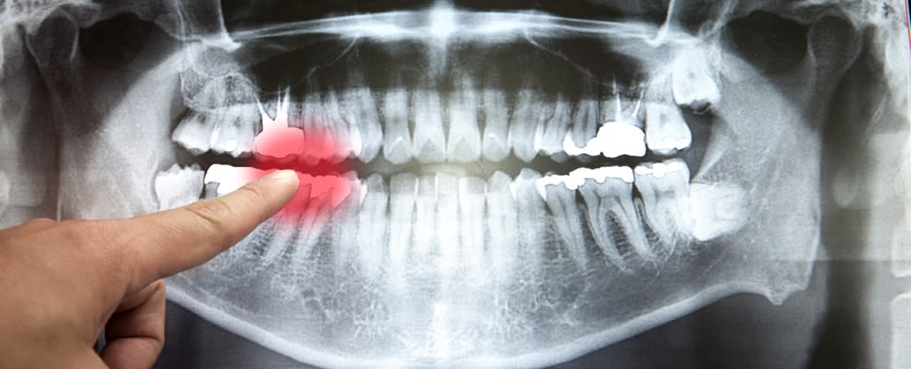 Finger Points At Teeth Xray