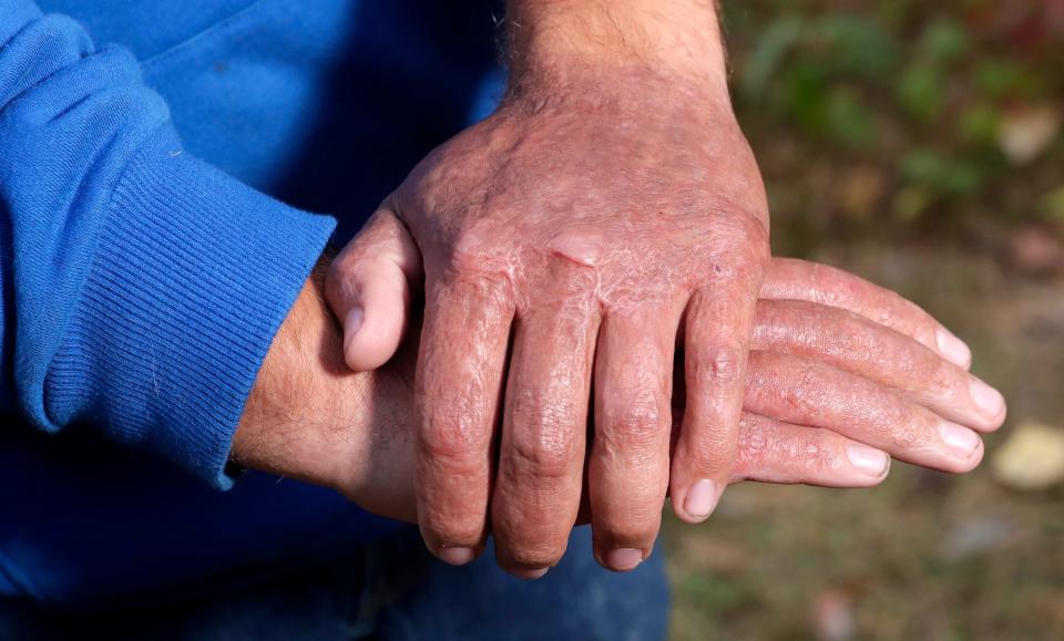 Brandon Brzeczkowski shows the scars on his hands a year after a bonfire explosion. He suffered burns on nearly 40% of his body.