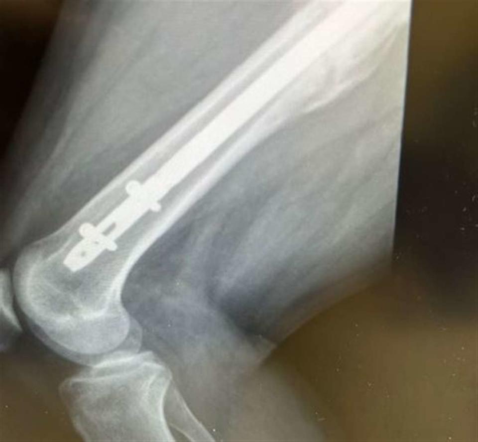 Darren Crooks x-ray from the hospital. (SWNS)