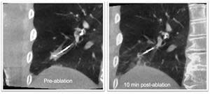 Philips-Azurion-lung-ablation