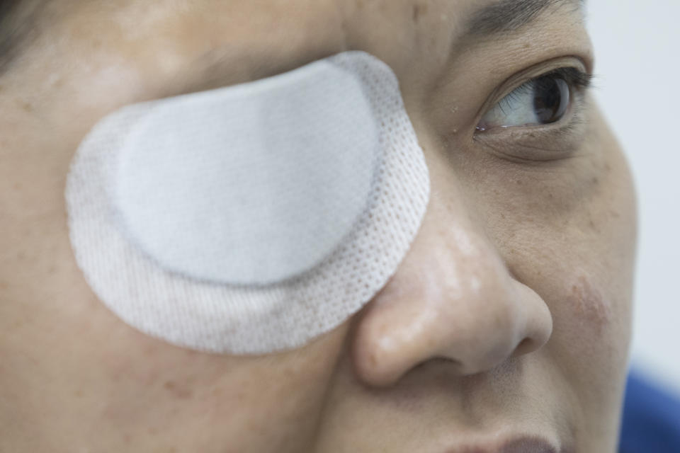 In this Wednesday, Dec. 4, 2019, photo, Veby Mega Indah, an injured Indonesian video journalist, speaks during an interview with The Associated Press in the Wan Chai area of Hong Kong. More than two months after being blinded in one eye by what she believes was a projectile fired by riot police, Indah is still seeking answers. On Sept. 29, 2019, Indah was among a group of reporters covering one of the hundreds of clashes between armed police and anti-government protesters that have broken out almost daily over the past six months. (AP Photo/Vincent Thian)