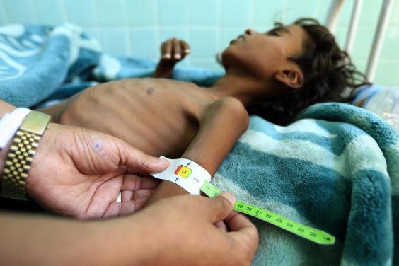 A doctor measures the arm of Yemeni Ali Mohammed Ahmed Jamal, 12, who is suffering from malnutrition