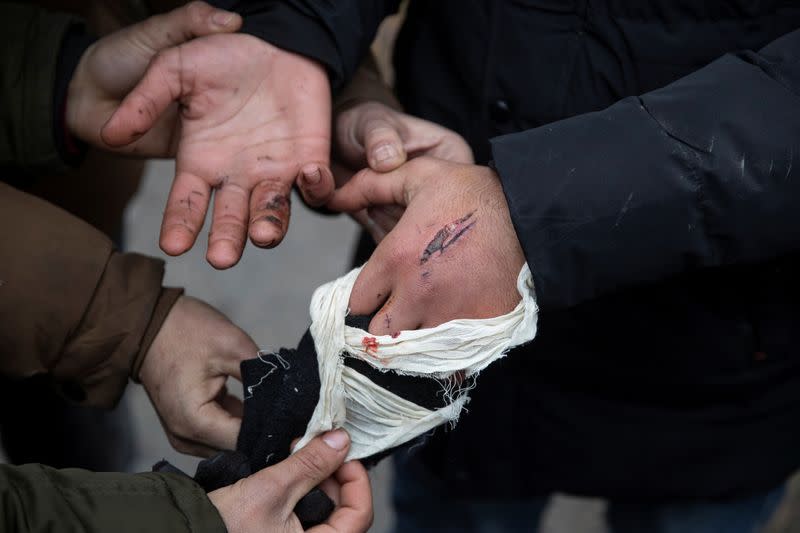 An injured migrant shows the wounds that he says are caused by Hungarian police in Horgos