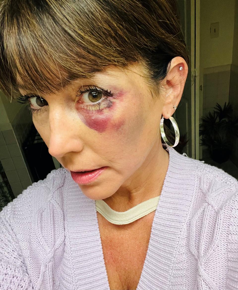 Kristi Moore has been an umpire for 10 years and serves as the head umpire in Mississippi for the United States Fastpitch Association. She suffered a black eye as a result of an attack after a 12-and-under game she umpired Saturday.
