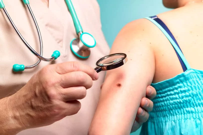 Health experts have outlined the signs of skin cancer