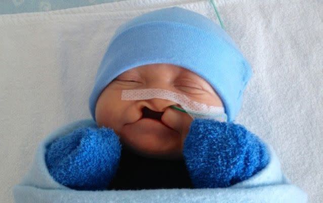 Robbie Milne was born with a cleft lip and palate, which occurs when the two halves of the palate or the lip don’t fuse together properly, leaving an open space. Photo supplied.