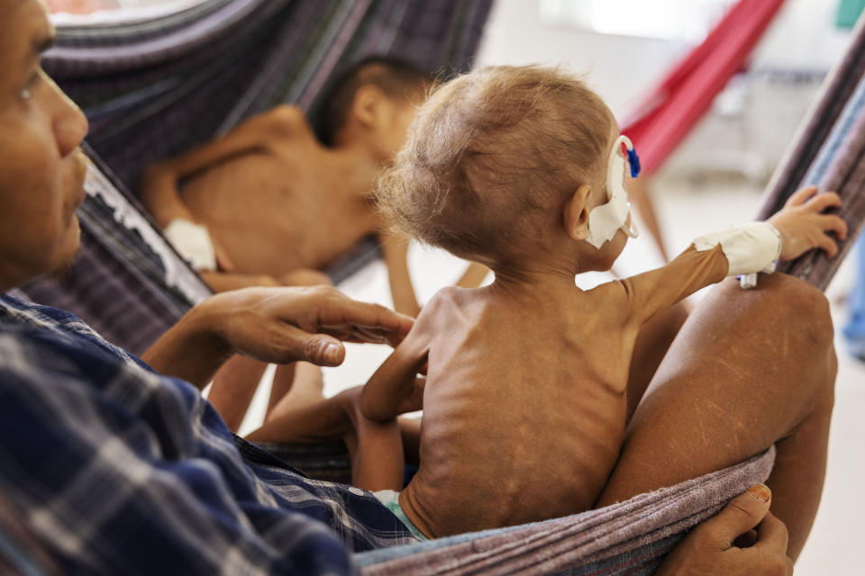 ***ARQUIVO***BOA VISTA, RR, 25.01.2023 - Criança yanomami internada com desnutrição em hospital de Boa Vista, em Roraima. (Foto: Lalo de Almeida/Folhapress)