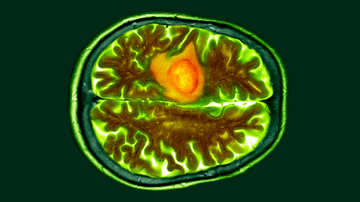  Colored CT scan of a section through a person's brain with a glioblastoma shown in orange on the left side of the brain (shown at the top in this image as rotated 90 degrees). 