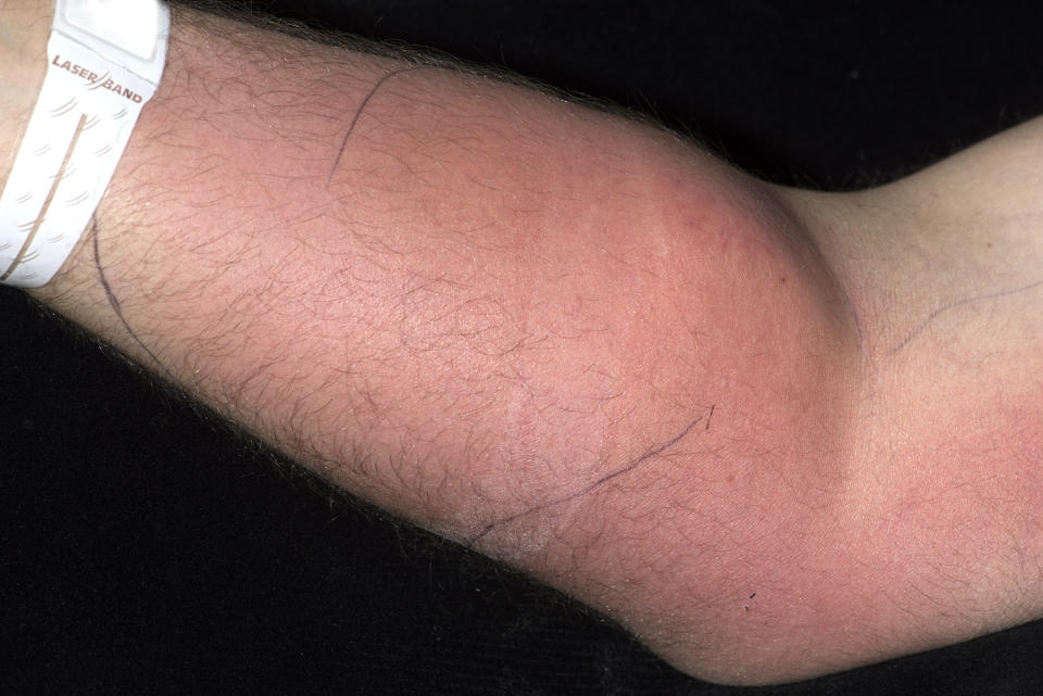 Cellulitis and edema of the man's right forearm. (Photo: <a href="http://imj.ie/semenly-harmless-back-pain-an-unusual-presentation-of-a-subcutaneous-abscess/" target="_blank">Irish Medical Journal</a>)