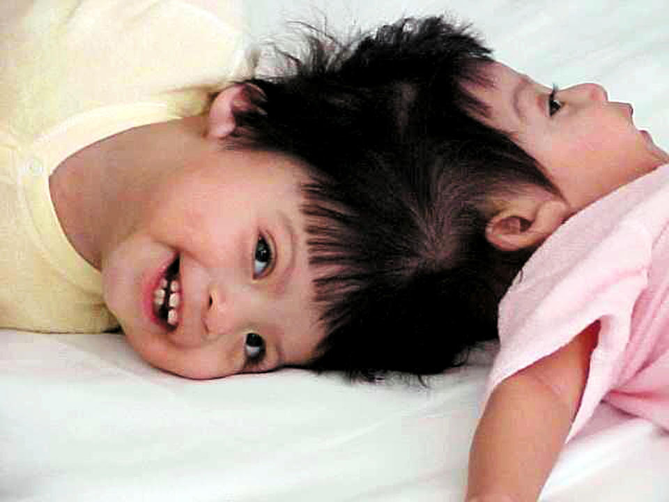 Formerly Conjoined Twins Teresa and Josie Turn 21: Inside Their Incredible Journey