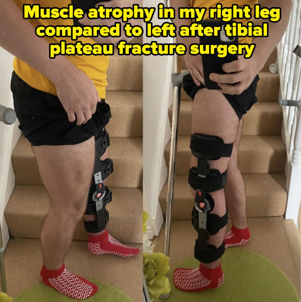 Person wearing a knee brace stands on stairs, with leg in knee brace much thinner than other leg