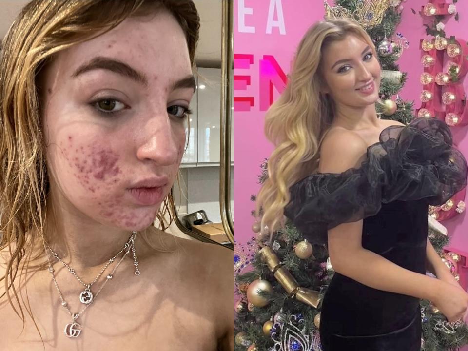 Eva Grant tiktok beauty pageants acne