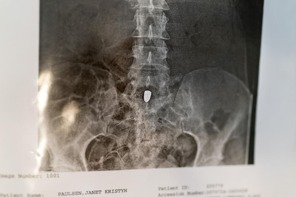 An X-ray shows a bullet lodged in Janet Paulsen’s spine after her estranged husband ambushed her in their garage in 2015 before turning the gun on himself. Paulsen, now partially paralyzed, still lives in the home in Acworth, Ga., Tuesday, Aug. 8, 2023. (AP Photo/David Goldman)