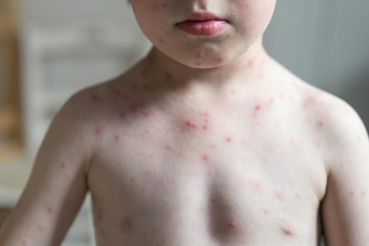 Child with varicella zoster virus and the skin condition chicken pox (Petko Ninov / Getty Images stock)