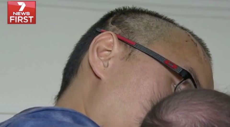 Head scars can still be seen on the man who was bashed in the attack. Source: 7 News