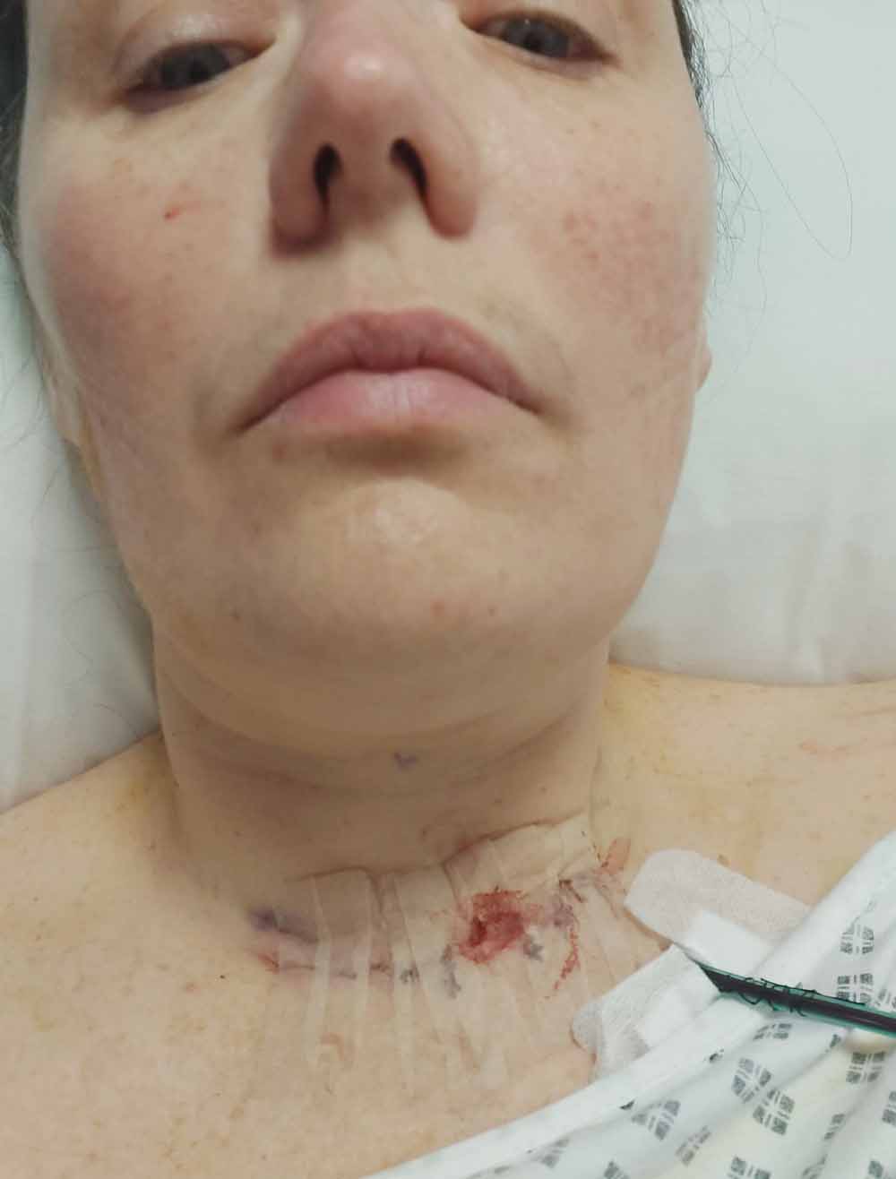 The mum-of-three had two operations on her thyroid. (PA Real Life)