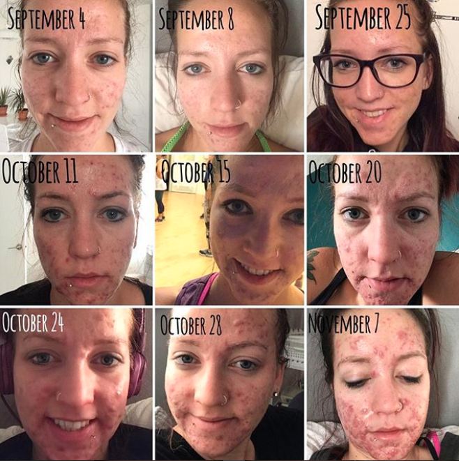 Here is a timeline of her acne struggles. (Photo: Instagram/stephmkt1d)