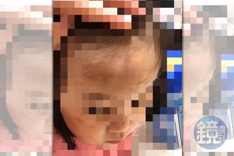 A先生控訴女兒被吳姓保母照顧後，額頭出現大面積瘀傷。（讀者提供）