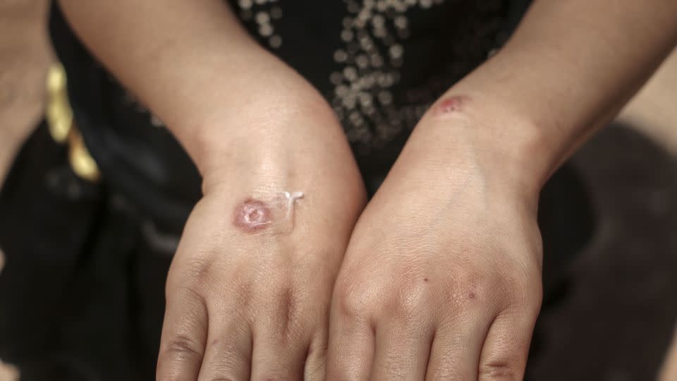 A child with leishmaniasis on her hands in Syria. - Muhammed Abdullah/Anadolu Agency via Getty Images