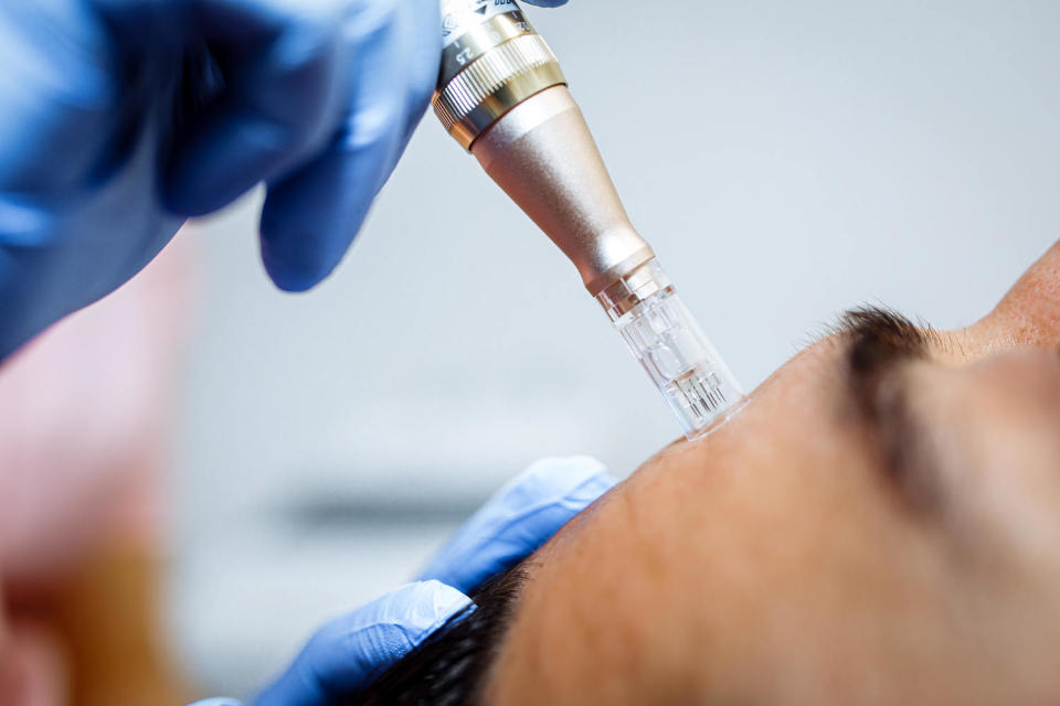 Close up of dermapen tool - device equipped with fine, sterile needles to create tiny punctures in skin. (Tatsiana Volkava / Getty Images)