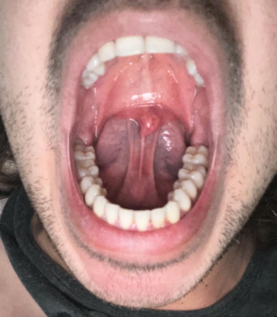 Close-up of a person's open mouth showing teeth and uvula, showing the tongue behind the uvula