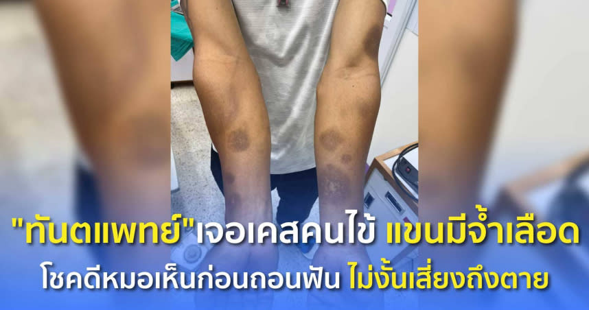 泰國一名病患在拔牙前被醫生發現罹患血小板低下症。（圖／翻攝自推特）