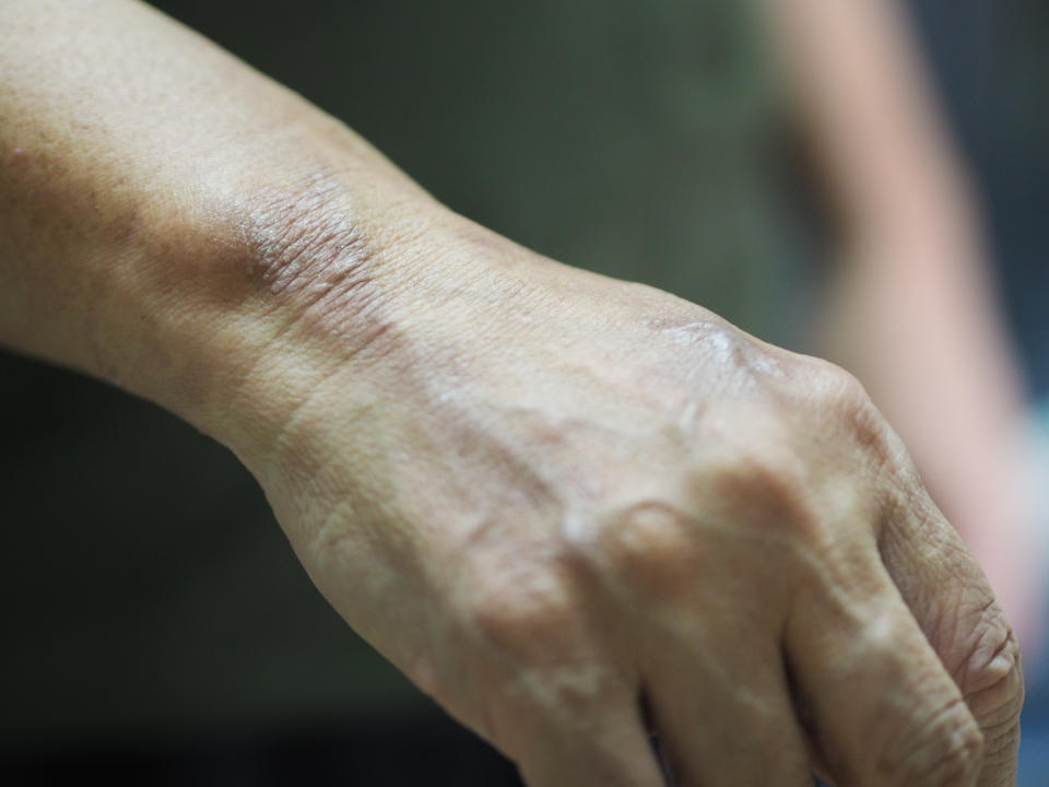 close up hand of Leprosy is easily detected and treated (Getty).