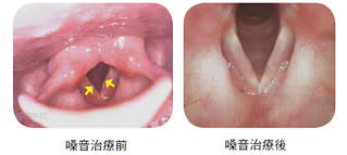 聲帶結節接受嗓音治療