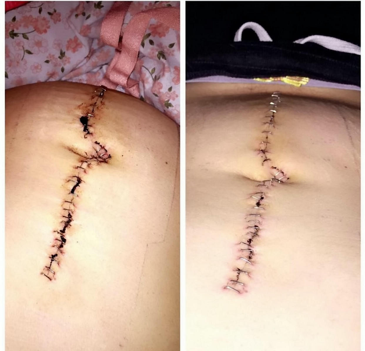 Katie's stitches from surgery. (SWNS)