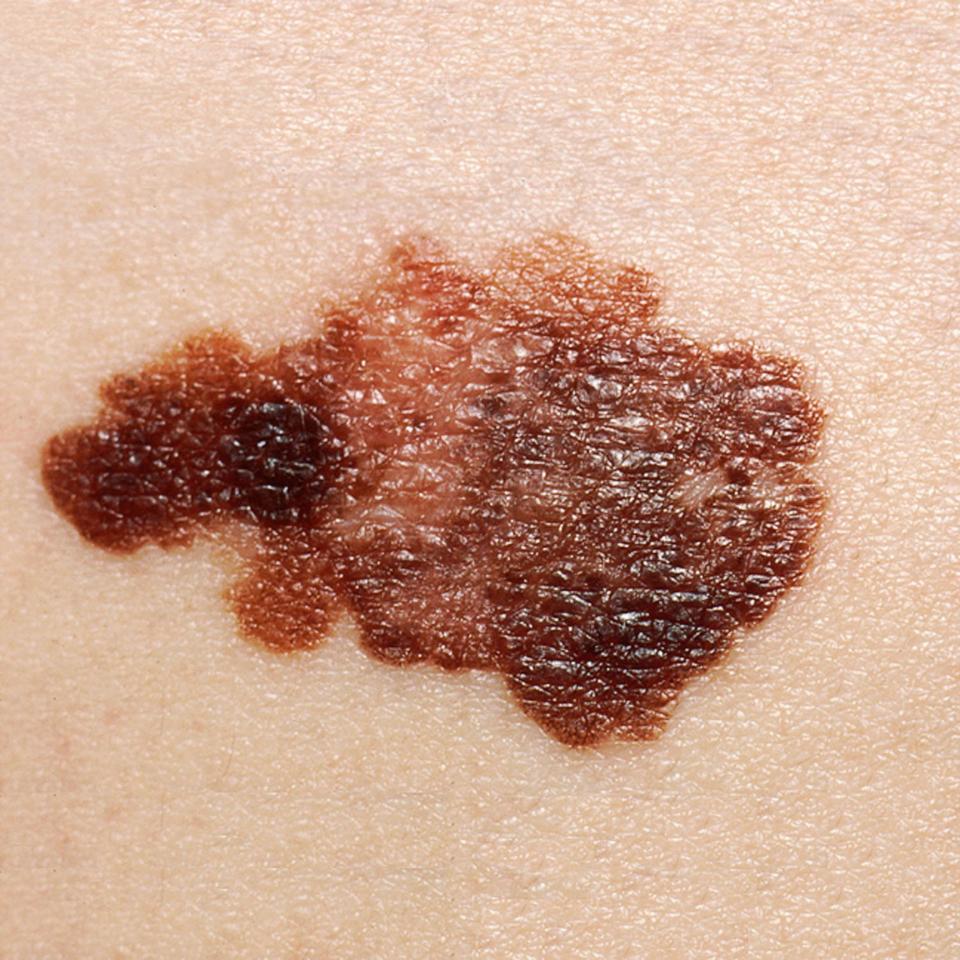 what-is-melanoma-your-skin-cancer-questions-answered