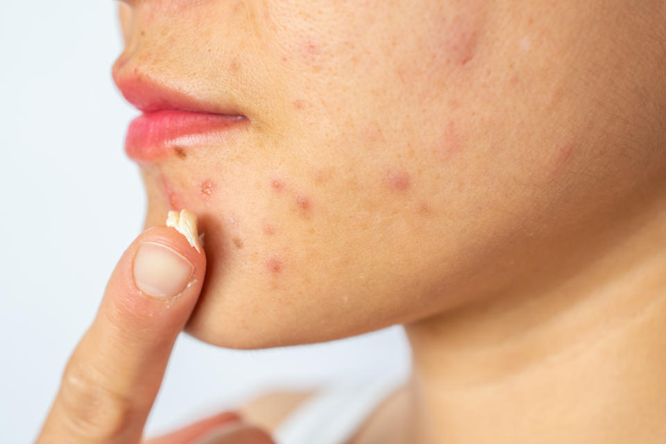 Conceptual of acne problems on woman skin.