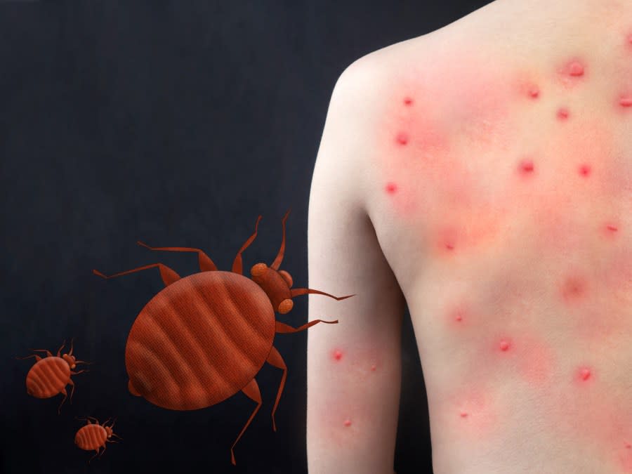 <em>Bed bug bites can result in red bumps appearing on the body. (Photo Courtesy/Getty Images)</em>