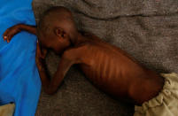 DieudonnŽ Sabwa, 4, an internally displaced and severely acute malnourished child waits to receive medical attention at the Tshiamala general referral hospital of Mwene Ditu in Kasai Oriental Province in the Democratic Republic of Congo, March 15, 2018. Picture taken March 15, 2018. REUTERS/Thomas Mukoya