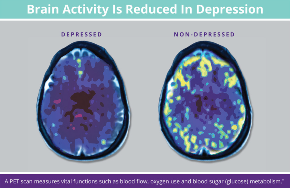 PET scan images measure vital functions such as blood flow, oxygen use, and blood sugar metabolism that demonstrate just how dramatically brain activity is reduced in depression. The image on the right is a non-depressed brain. Notice all bright yellows and greens that reflect the vibrant brain activity of a person who is not currently experiencing depression. The image on the left of a depressed brain tells a different story. As you can see, there are hardly any bright colors that indicate healthy blood flow and activation. Instead, the brain is almost completely dark and lacks any significant activity. When a client receives a Transcranial Magnetic Stimulation treatment, the brain is mapped to identify areas that are lacking these vital functions and activation.