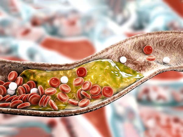 Atheromatous plaque in artery, illustration