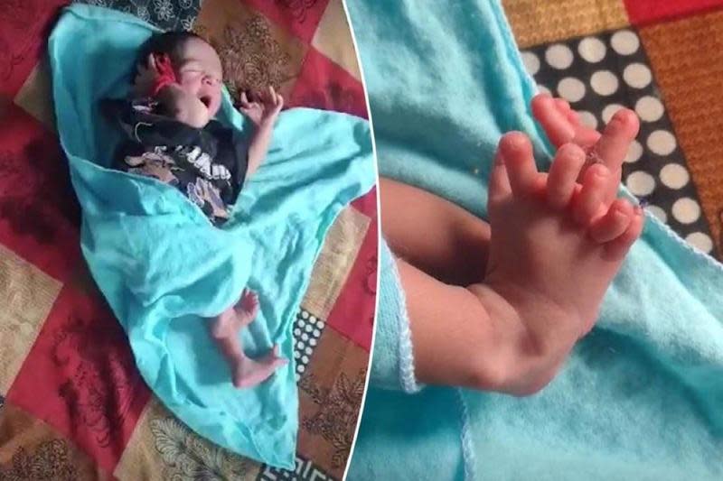 印度一名早產女嬰因基因異常，所以出生就擁有26根手指、腳趾。（翻攝X@thevirall）