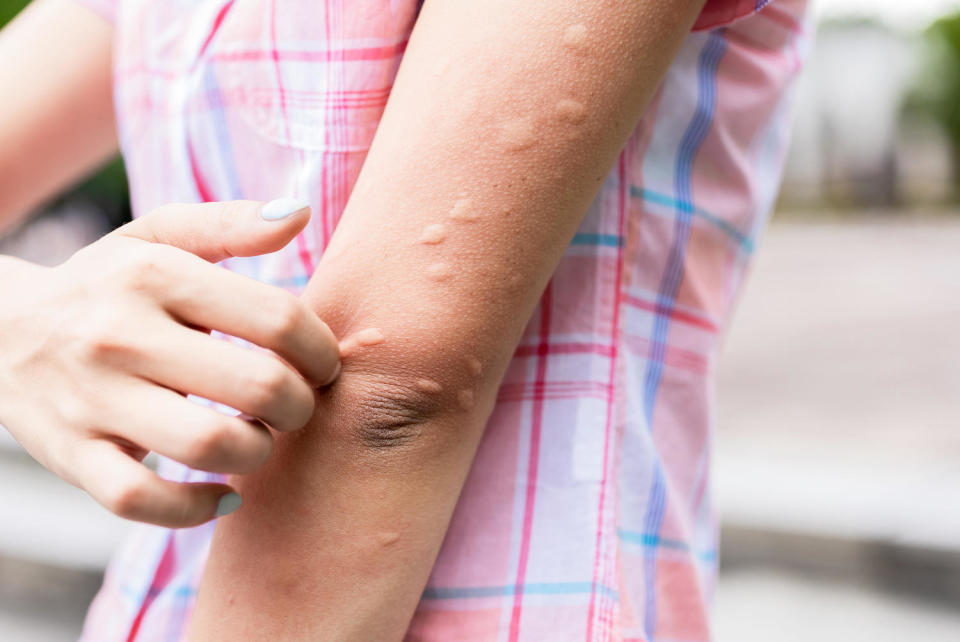 Arm of a girl that was bitten by mosquitoes. (Getty Images)