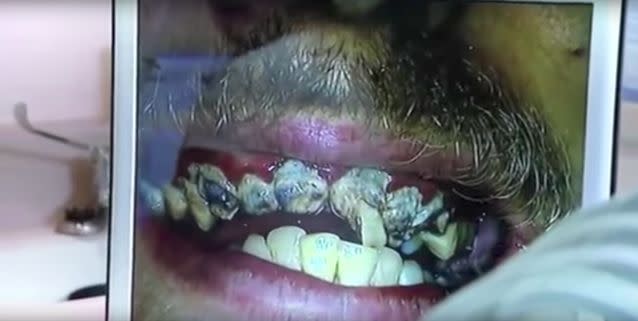 Curse of the black pearls: Jay learnt the hard way about the benefits of good dental hygiene. Source: Channel 4